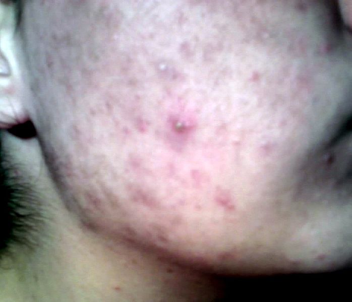 File:Teenager-with-acne.jpg