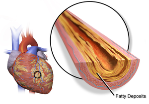 Blausen 0257 CoronaryArtery Plaque.png