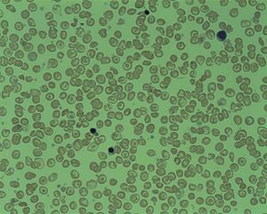 Delta Beta Thalassemia.jpg